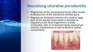 Necrotizing ulcerative periodontitis
• Progression of the interproximal lesion often results
in destruction of the interdental alveolar bone.
• Sequestrum formation:necrosis of a small or large
part of the alveolar bone,which is denoted as
sequestrum.the bone fragement is initially
immovable, later on it becomes loose.sequestrum
involves interproximal as well as facial or palatal
cortical bone.
 