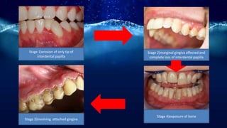 Stage 1)erosion of only tip of
interdental papilla
Stage 2)marginal gingiva affected and
complete loss of interdental papilla
Stage 3)involving attached gingiva
Stage 4)exposure of bone
 