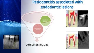 Periodontitis associated with
endodontic lesions
Combined lesions
Periodontic
lesions
Endodontic
lesions
 