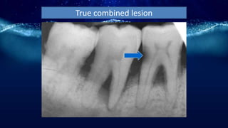 True combined lesion
 