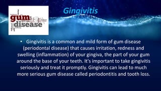 Gingivitis
• Gingivitis is a common and mild form of gum disease
(periodontal disease) that causes irritation, redness and
swelling (inflammation) of your gingiva, the part of your gum
around the base of your teeth. It's important to take gingivitis
seriously and treat it promptly. Gingivitis can lead to much
more serious gum disease called periodontitis and tooth loss.
 