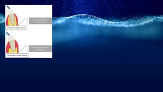 Periodontal disease [autosaved]