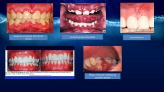 Gingivitis associated with dental
plaque
Herpetic gingivostomatitis
Plaque induced modified by
systemic factors
Chemical burn
 