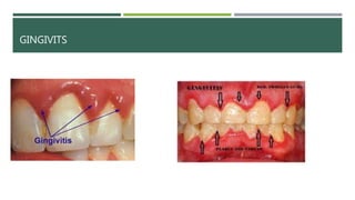 GINGIVITS
 