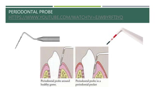 PERIODONTAL PROBE
HTTPS://WWW.YOUTUBE.COM/WATCH?V=EJWBYRFTIYQ
 