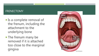 FRENECTOMY
 Is a complete removal of
the frenum, including the
attachment to the
underlying bone
 The frenum many be
removed if it is attached
too close to the marginal
gingiva
 