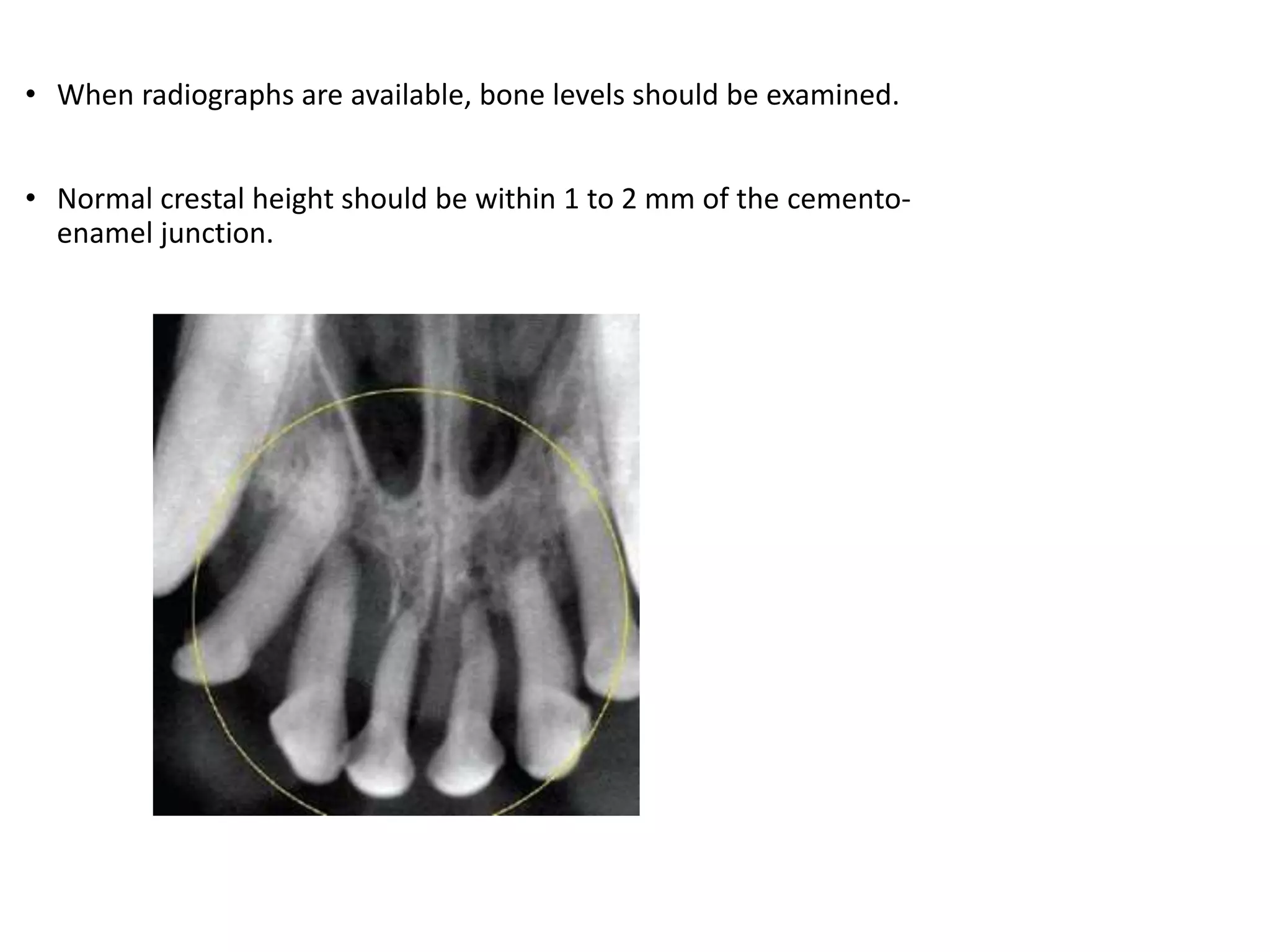 Normal Bone Level Radiograph Periodontal disease in children -pedodontics | PPTX