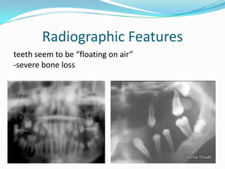 Floating Tooth Periodontal diseases in children | PPTX