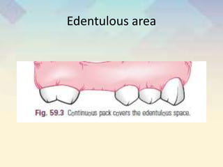 Edentulous area
 