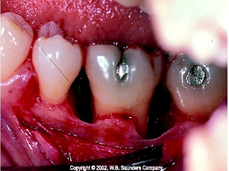 Periodontal dressings