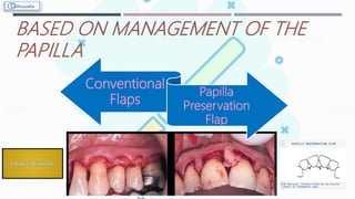 BASED ON MANAGEMENT OF THE
PAPILLA
Conventional
Flaps
Papilla
Preservation
Flap
 