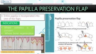 THE PAPILLA PRESERVATION FLAP
 Entire papilla is incorporated into
one of the flaps.
INDICATIONS
• Where esthetics is of
concern
• Where bone regeneration
techniques are attempted
References : Kromer H – 1956; 66; Evian CI, Rosenberg ER - 1985
 