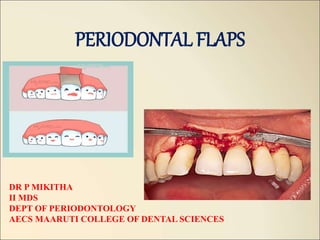 PERIODONTAL FLAPS
DR P MIKITHA
II MDS
DEPT OF PERIODONTOLOGY
AECS MAARUTI COLLEGE OF DENTAL SCIENCES
 