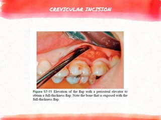 CREVICULAR INCISION
 