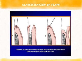 CLASSIFICATION OF FLAPS
 