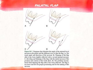 PALATAL FLAP
 