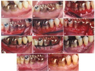APICALLY DISPLACED FLAP
 
