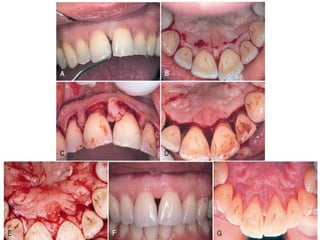 PAPILLA PRESERVATION FLAP
 