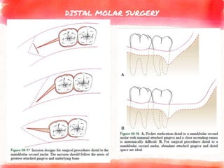 DISTAL MOLAR SURGERY
 