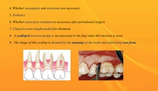 4. Whether osteoplasty and ostectomy are necessary
5. Esthetics
6. Whether restorative treatment is necessary after periodontal surgery
7. Clinical crown length needed for abutment
 A scalloped incision design is incorporated in the flap when this incision is used.
 The shape of this scallop is dictated by the anatomy of the tooth and underlying root form.
23
 