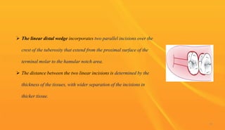 Periodontal flap surgery | PPTX