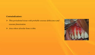 Contraindications:
 Thin periodontal tissue with probable osseous dehiscence and
osseous fenestration.
 Area where alveolar bone is thin.
44
 