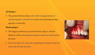 Advantages:
 The partial-thickness flap is favorable in augmentation of
attached gingiva with thin bone (done by positioning the flap
apically or laterally)
Disadvantages:
 The biggest problem of a partial-thickness flap is with the
thickness of the remaining periosteum-connective tissue bed on
the bone.
 If it is less than 0.5-1 mm, the remaining periosteum-connective
tissue may become necrotic.
46
 
