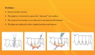 Technique :
 Intracrevicular incision.
 The gingiva is retracted to expose the “diseased” root surface.
 The exposed root surfaces are subjected to mechanical debridement.
 The flaps are replaced to their original position and sutured.
54
 