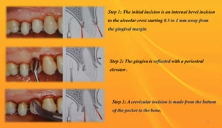 58
Step 1: The initial incision is an internal bevel incision
to the alveolar crest starting 0.5 to 1 mm away from
the gingival margin
Step 2: The gingiva is reflected with a periosteal
elevator .
Step 3: A crevicular incision is made from the bottom
of the pocket to the bone,
 