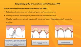 To overcome technical problems encountered with the MPPT
 Difficult application in narrow interdental spaces and in posterior areas
 Suturing technique not appropriate for use with non supportive barriers
 Modified papilla preservation is used in wide interdental spaces (>2mm ) especially in anterior
dentition.
Simplified papilla preservation( Cortellini et al,1999)
Sulcular incisions and buccal flap
elevation
Oblique incision in papilla begins at the gingival
margin line angle, blade parallel to the long
axis of the tooth and reaches the midpoint of the
distal surfaceof adjacent tooth below the
contact point
Palatal flap reflection
71
 