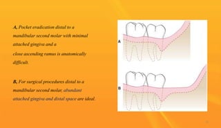 A, Pocket eradication distal to a
mandibular second molar with minimal
attached gingiva and a
close ascending ramus is anatomically
difficult.
B, For surgical procedures distal to a
mandibular second molar, abundant
attached gingiva and distal space are ideal.
76
 