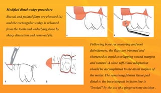 Modified distal wedge procedure
Buccal and palatal flaps are elevated (a)
and the rectangular wedge is released
from the tooth and underlying bone by
sharp dissection and removed (b).
Following bone recontouring and root
debridement, the flaps are trimmed and
shortened to avoid overlapping wound margins
and sutured .A close soft tissue adaptation
should be accomplished to the distal surface of
the molar. The remaining fibrous tissue pad
distal to the buccolingual incision line is
"leveled" by the use of a gingivectomy incision .
78
 