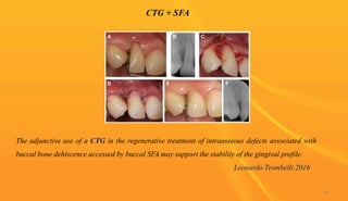 CTG + SFA
84
The adjunctive use of a CTG in the regenerative treatment of intraosseous defects associated with
buccal bone dehiscence accessed by buccal SFA may support the stability of the gingival profile.
Leonardo Trombelli 2016
 
