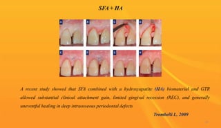 SFA + HA
85
A recent study showed that SFA combined with a hydroxyapatite (HA) biomaterial and GTR
allowed substantial clinical attachment gain, limited gingival recession (REC), and generally
uneventful healing in deep intraosseous periodontal defects
Trombelli L, 2009
 