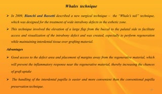 Whales technique
 In 2009, Bianchi and Bassetti described a new surgical technique – the “Whale’s tail” technique,
which was designed for the treatment of wide intrabony defects in the esthetic zone.
 This technique involved the elevation of a large flap from the buccal to the palatal side to facilitate
access and visualization of the intrabony defect and was created, especially to perform regeneration
while maintaining interdental tissue over grafting material.
Advantages
 Good access to the defect area and placement of margins away from the regenerative material, which
will prevent the inflammatory response near the regenerative material, thereby increasing the chances
of graft uptake
 The handling of the interdental papilla is easier and more convenient than the conventional papilla
preservation technique.
86
 