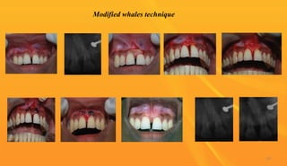 Modified whales technique
89
 