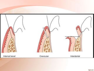 periodontal flap surgery.pptx