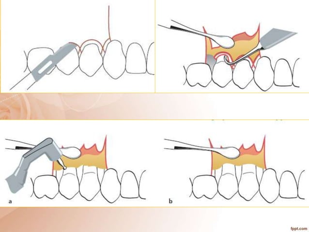periodontal flap surgery.pptx | Oral care | Personal Care