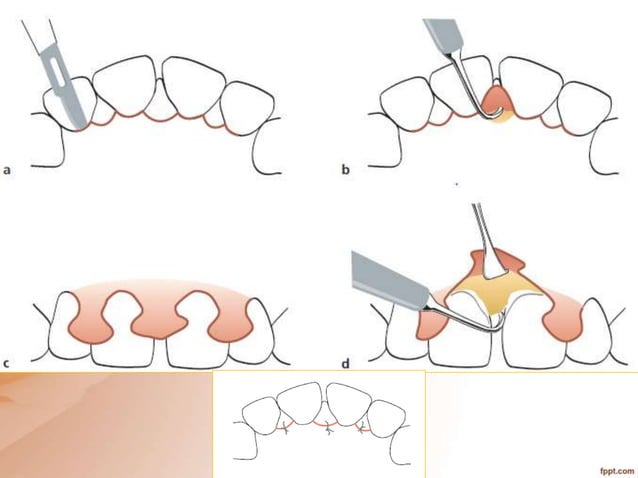 periodontal flap surgery.pptx | Oral care | Personal Care