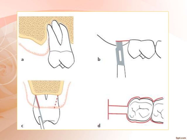periodontal flap surgery.pptx | Oral care | Personal Care