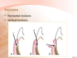 periodontal flap surgery.pptx