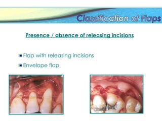 Presence / absence of releasing incisions
Flap with releasing incisions
Envelope flap
 