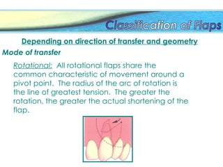 Depending on direction of transfer and geometry
Mode of transfer
Rotational: All rotational flaps share the
common characteristic of movement around a
pivot point. The radius of the arc of rotation is
the line of greatest tension. The greater the
rotation, the greater the actual shortening of the
flap.
 