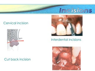 Cervical incision
Interdental incisions
Cut back incision
 