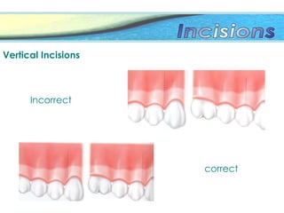 Vertical Incisions
Incorrect
correct
 