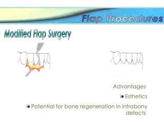 Advantages
Esthetics
Potential for bone regeneration in intrabony
defects
 