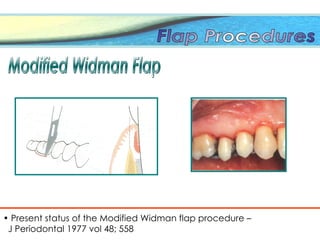 • Present status of the Modified Widman flap procedure –
J Periodontal 1977 vol 48; 558
 
