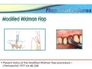 • Present status of the Modified Widman flap procedure –
J Periodontal 1977 vol 48; 558
 