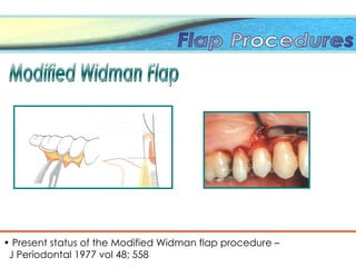 • Present status of the Modified Widman flap procedure –
J Periodontal 1977 vol 48; 558
 