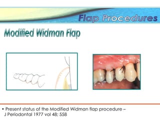 • Present status of the Modified Widman flap procedure –
J Periodontal 1977 vol 48; 558
 